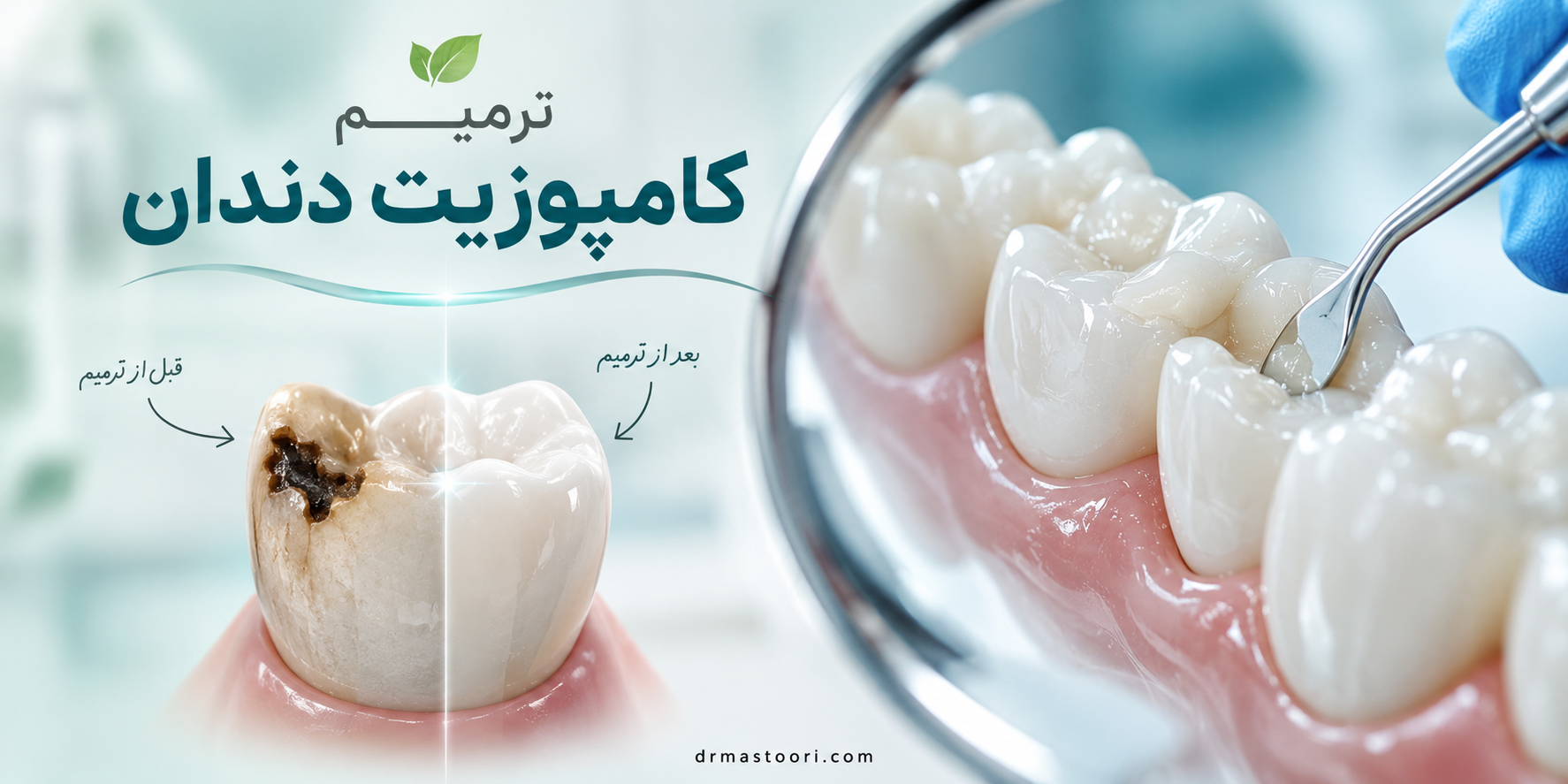 ترمیم کامپوزیت دندان 1